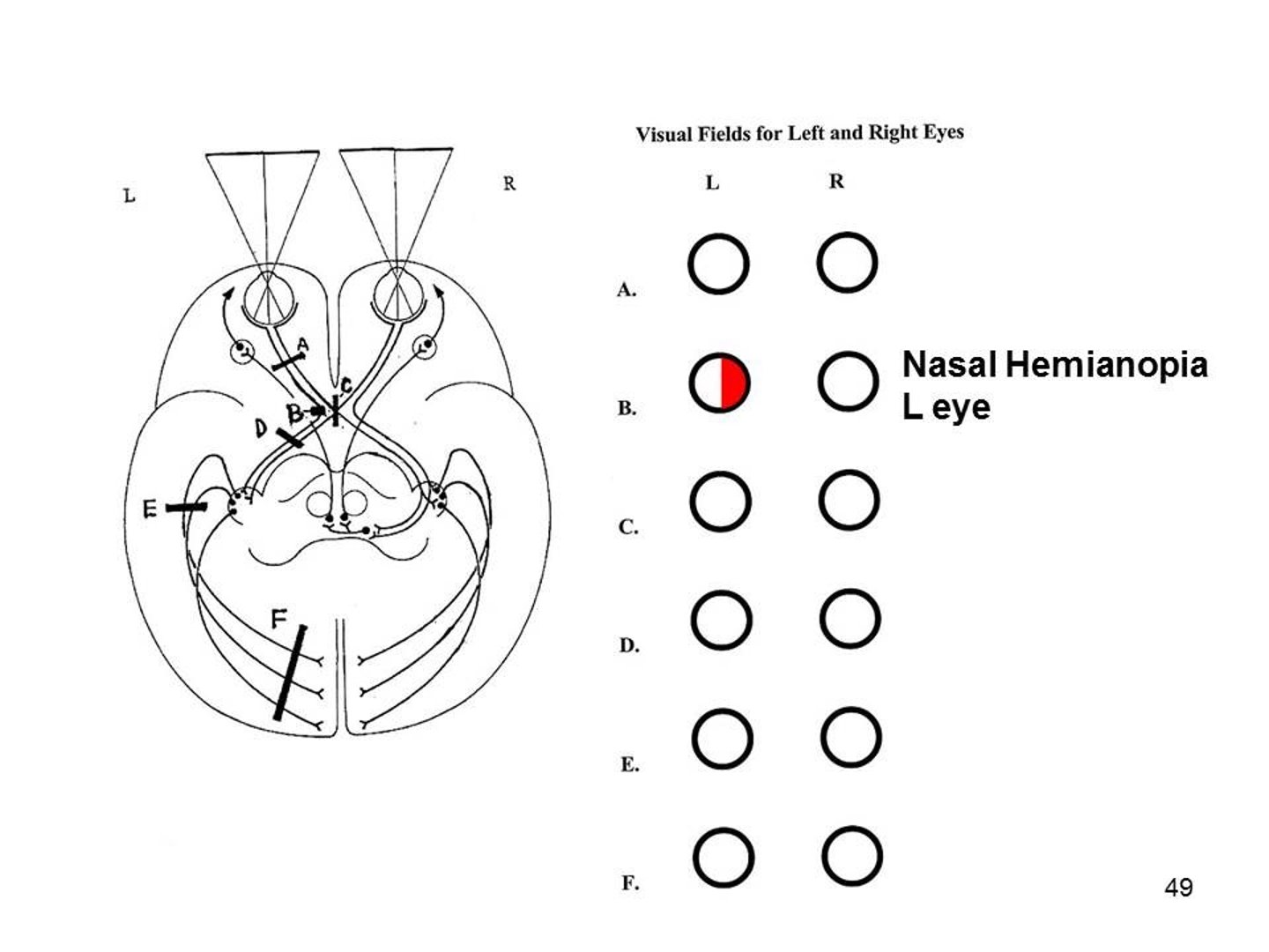 <p>left nasal hemianopia</p>