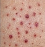 <p><span>Tiny, flat, reddish-purple, non-blanchable spots in the dermal layer; 1 to 3 mm (or <0.5 cm) in size (e.g., bleeding disorders, tiny capillary hemorrhages due to infection)</span></p>