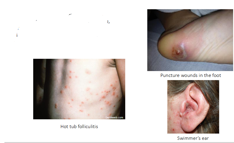 <p>P. aeruginosa infections in healthy patients</p>