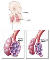 <p>respiratory distress syndrome</p>