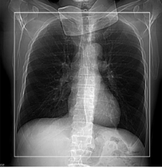 <p>Start location: Just above lung apices End location: Just below costophrenic angles (note: for known or suspected lung cancer, end just below adrenal glands)</p>