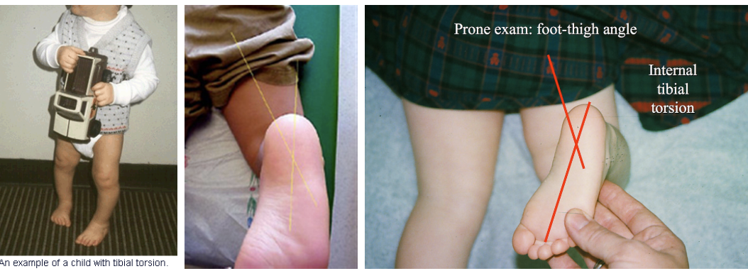 <p><span>internal rotation of the tibia and an in-toeing gait.</span></p><p>thigh foot angle > 10 degrees</p><p>seen in infants < 4</p>