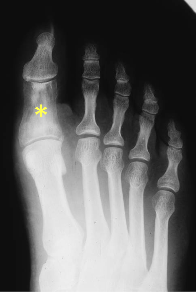<p>What tumour like disorder is this?</p>