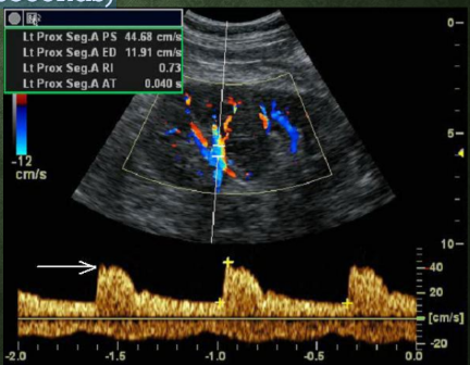 <p>Low resistance</p><p>• RI is less than 0.75</p><p>• Early systolic peak (ESP) is present</p><p>• Acceleration time (less than 0.07seconds)</p>