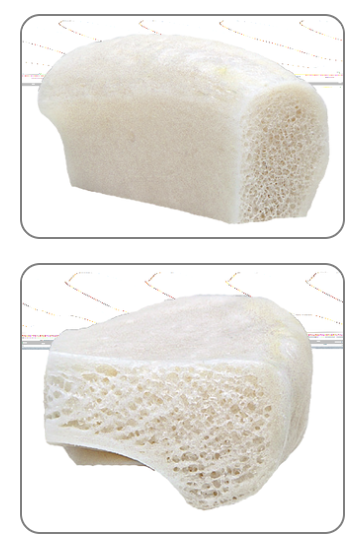 <p>Ilium strips with three cortical faces…a BIG ICW</p>