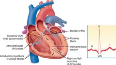 <p>Narrowing or blockage of a coronary artery.</p>