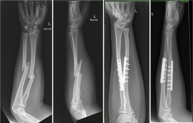 <ul><li><p>Happen anywhere along the ulna and radius </p></li><li><p>Usually have to be fixed with plates and screws </p></li></ul><p></p>