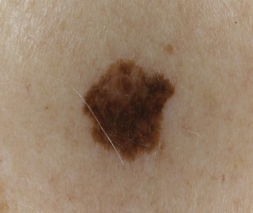 <p>a color different from that of the surrounding tissue; it is flat and does not protrude above the surface of the normal tissue (i.e. freckle)</p>