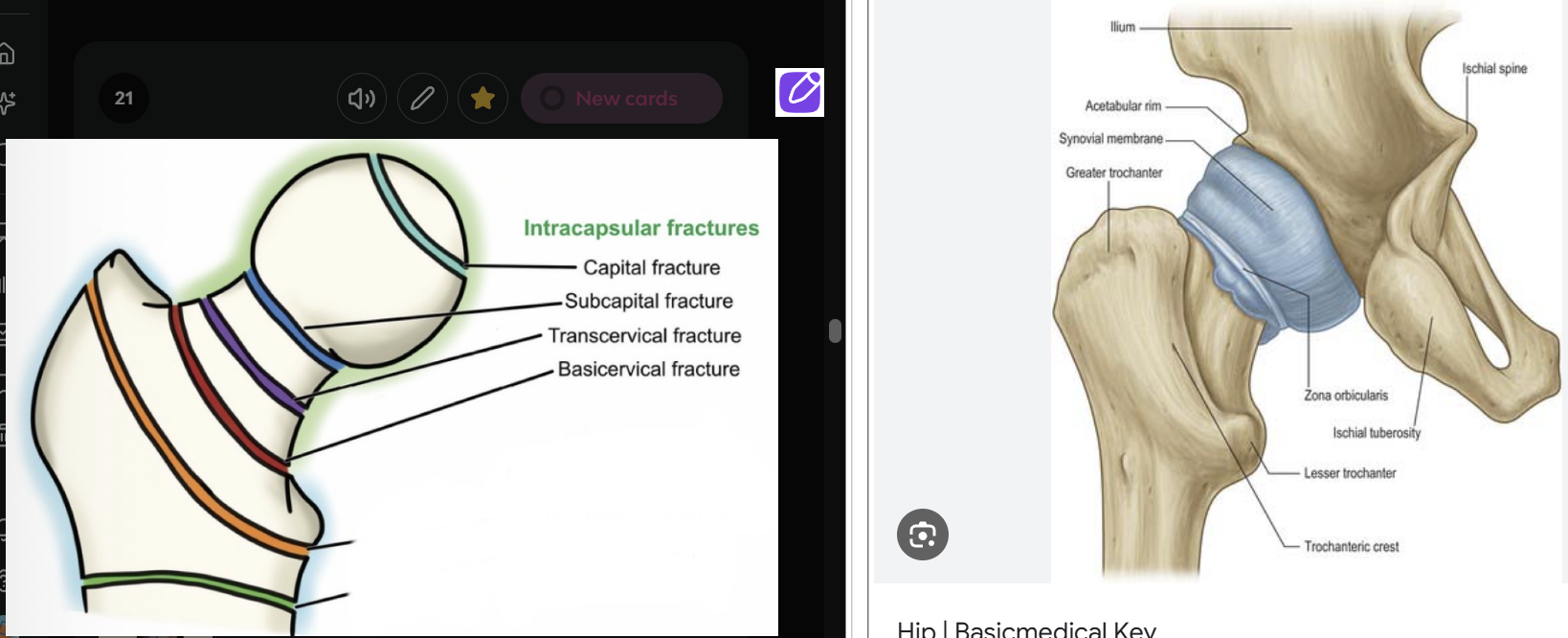 <p>Intracapsular = involving femoral head and neck</p><p>Risk = can damage blood supply to femoral head, increasing the chance of</p><ul><li><p><strong>avascular necrosis</strong> (cutting off the bones blood supply which can lead to death of the bone tissue)</p></li><li><p><strong>nonunion </strong>(bone fails to heal)</p></li><li><p><strong>malunion</strong> (bone heals in the wrong position)</p></li></ul><p></p>