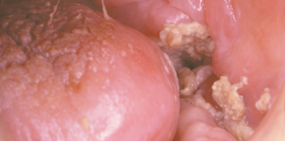 <p>manifestation of osteoradionecrosis </p>