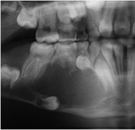<p>A 35 year old patient present with mild swelling of lower jaw. Intra orally a small swelling was visible over left third molar region. Radiographic and histologic images are shown below</p>