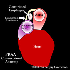 <p>Persistent right 4th aortic arch --> resection of ligamentum arteriosum </p><p>**Right 3rd becomes right internal carotid</p>