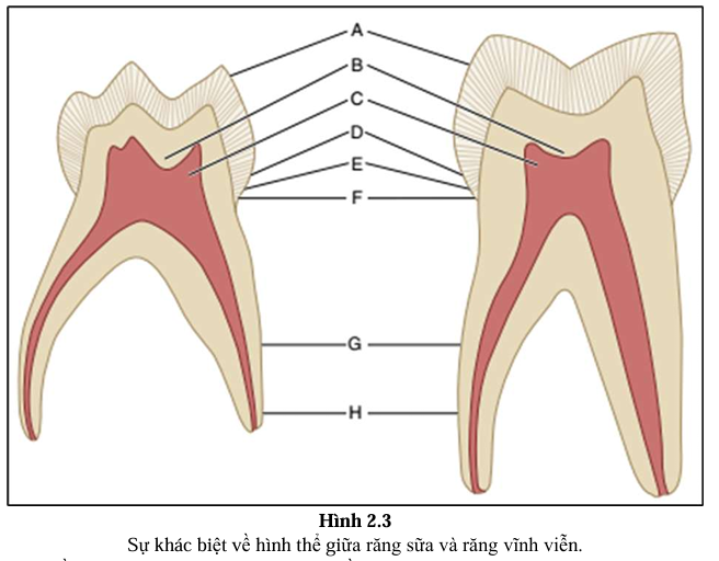 <p>Trụ men ở cổ răng <strong>nghiêng về phía mặt nhai</strong> (thay vì nghiêng về phía nướu như ở răng vĩnh viễn).</p><p></p>