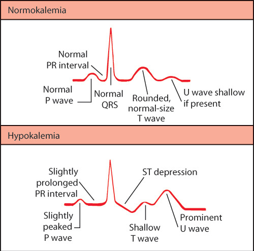 <p>Flattened or inverted T waves, the presence of U waves (a small wave appearing after the T wave), and possible ST segment depression</p>
