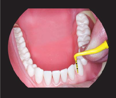 <p>Student must see</p><ul><li><p>Patient’s head</p></li><li><p>Clinician’s arms/ hands/ fingers</p></li><li><p>Oral cavity</p></li><li><p>Patient positioning</p></li><li><p>Mirror use</p></li><li><p>Finger rests</p></li></ul><p></p><p><strong>Limited field of vision</strong></p><p>Loupes are given if the student has mastered the fundamental skills of patient positioning, clock positions, mirror use, finger rests</p><p></p>