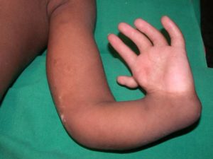 <p>A congenital condition caused by the failure of the radius and adjacent soft tissue to develop, causing the hand to be medially deranged. Typically associated with deformities of the thumb</p>