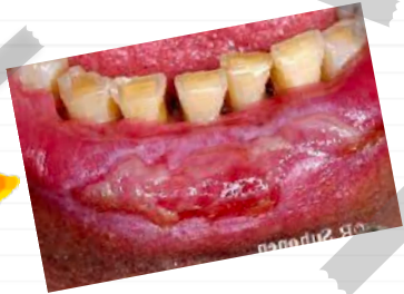 <p>autoimmune condition that causes <strong>erosions </strong>on mucosal surfaces, leading to <strong>ulceration</strong></p>