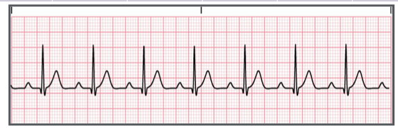 <p>Identify the above waveform:</p><p>a. First degree heart block</p><p>b. Third degree heart block</p><p>c. normal sinus rhythm</p><p>d. Second degree heart block type I</p>