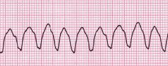 <p>Ventricular Tachycardia (V-Tach)</p>