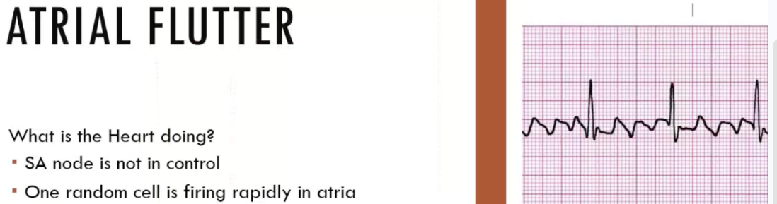 <p>atrial flutter</p>