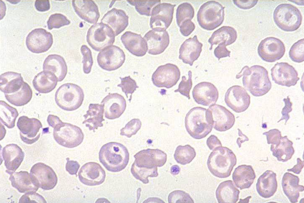 <p>what hemoglobinopathy is this?</p>