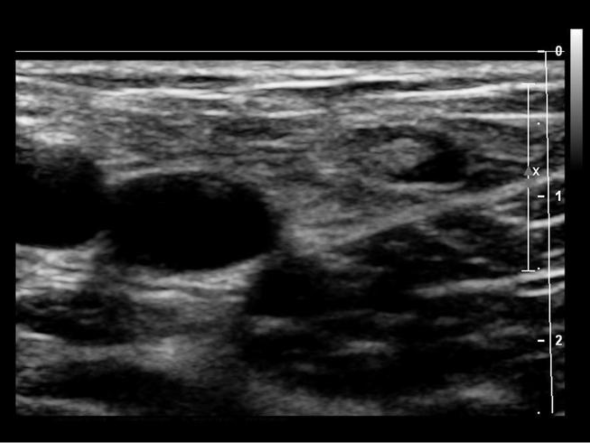 <p>Find the normal lymph node</p>