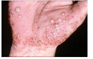 <p>What is this disease?</p>
