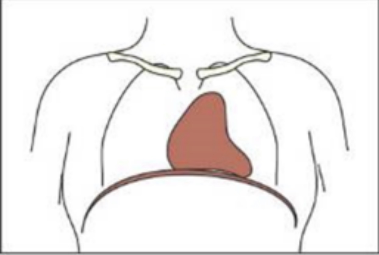 <p>Diaphragm wider</p><p>Lungs are narrow and short</p><p>Thorax short</p>