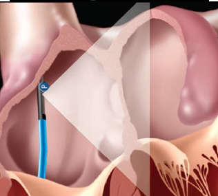 <p>ICE Transseptal view</p>