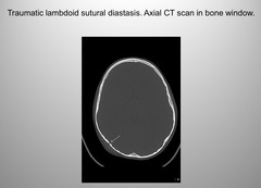 <p>Sutural diastasis</p>