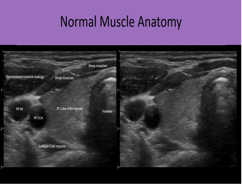 <p>C. longus colli muscle</p><p>Strap muscles are anteromedial to the gland. Sternocleidomastoid muscles are anterolateral to the gland. Longus Colli muscles are posterior to the thyroid lobes.</p>