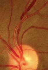 <p>What are the vessel color changes that occur with hypertension retinopathy?</p>