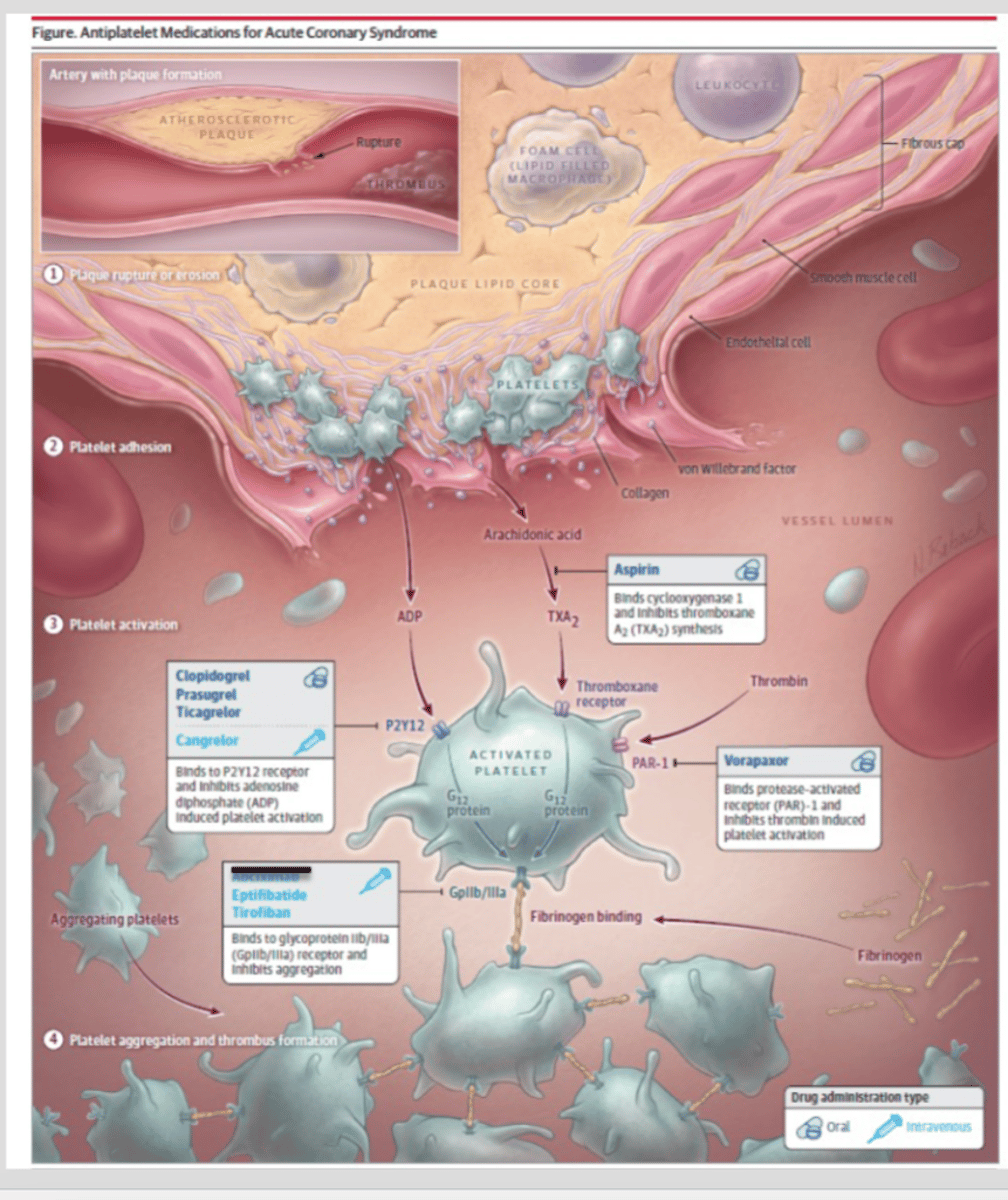 <p>1. Artery with plaque ruptured</p><p>2. Collagen exposed, which initially activates platelets</p><p>3. Other factors like thromboxane, thrombin, ADP, epinephrine, and serotonin&nbsp;are&nbsp;also released. All these activate platelets further.</p><p>4. Once these bind to their specific sites on platelets, Ca2+ is released inside the platelet.&nbsp;This causes the platelet to change from disk to a different shape (sphere w/ arms). This increases the SA to expose more places for platelet activators to bind.</p><p>5. Platelets themselves also release granules of TXA, ADP and serotonin to further activate platelets that are near the injury but aren't stuck on the injury. </p><p>6. Where you see overlap w/ the coagulation cascade, thrombin also activates platelets through thrombin receptors</p><p>7. Platelet activation causes increased expression of GP IIb/IIIa receptors</p><p>8. When GIIb/IIIa receptors are activated on platelets, they change shape to expose the binding area for fibrinogen (which helps link other platelets together by also converting into fibrin)</p><p>END PRODUCT: fibrin-platelet clot </p>