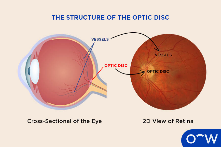 <p>Point where optic nerve leaves eye</p><p></p><p>blind spot of eye</p>