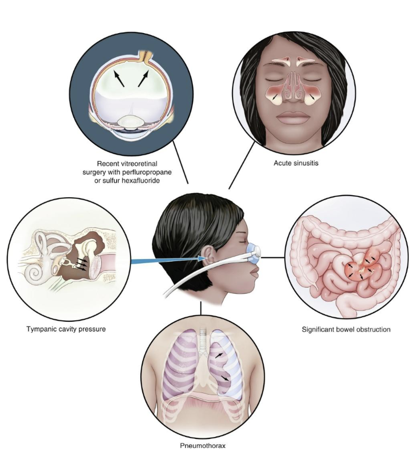 <p>nitrous enters spaces 34x faster than nitrogen leaves, increasing pressure and volume</p>