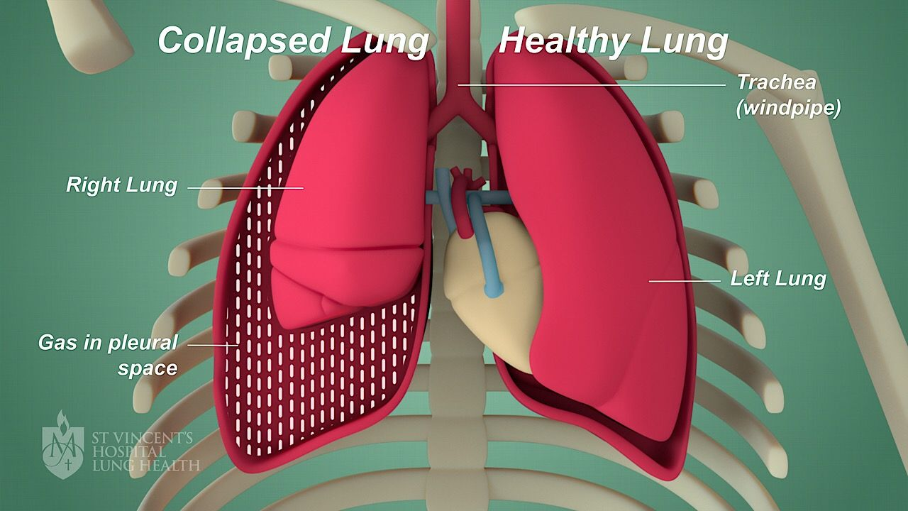 <p>collapsed lung</p>