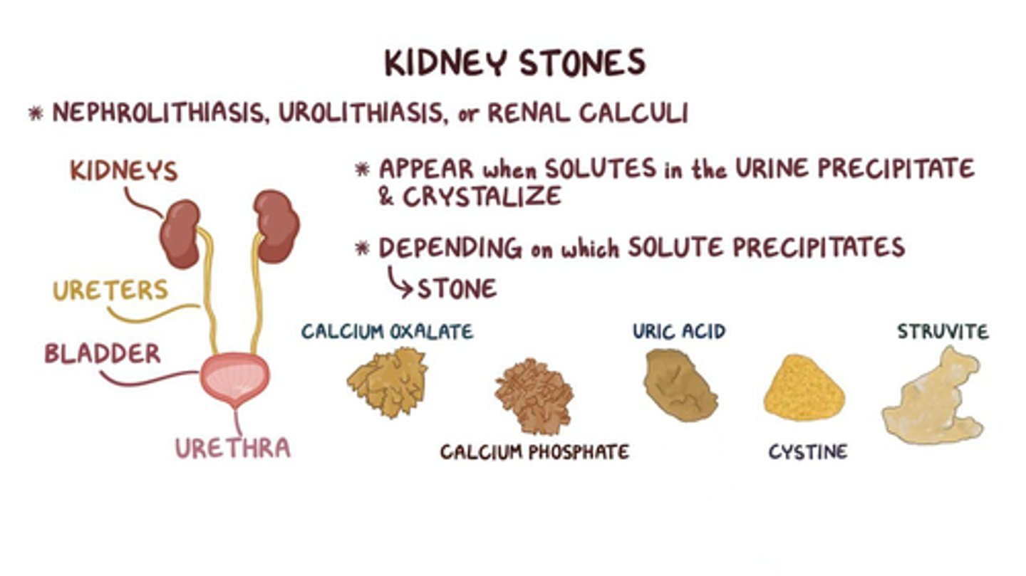 <p>B) Hypercalcemia stones: caused by high urine calcium levels, form readily with highly alkaline urine; Uric acid stones: caused by gout, high-purine diet (red meat, alcohol), or chemotherapy, form easily with acidic urine</p>