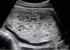 <p>'SNOWSTORM' appearance (or swiss cheese/ cluster of grapes) </p><p>No fetus/amniotic fluid, + heterogeneous mass with anechoic spaces,</p>