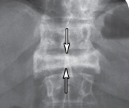 <p>Vertebrae collapse under extreme stress (associated with osteoporosis)</p>
