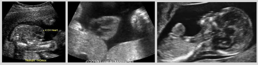 <ul><li><p><span style="background-color: transparent;">Herniation of heart into amniotic cavity through defect</span></p></li><li><p><span style="background-color: transparent;">US findings: heart seen outside of thoracic cavity</span></p></li></ul><p></p>