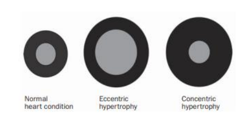 <p><span style="background-color: transparent;">quatre cases de coeur :&nbsp;</span></p><ul><li><p><span style="background-color: transparent;">coeur normal</span></p></li></ul><ul><li><p><span style="background-color: transparent;">hypertrophie excentrique</span></p></li><li><p><span style="background-color: transparent;">hypertrophie concentrique</span></p></li><li><p><span style="background-color: transparent;">remodelage concentrique</span></p></li></ul><p><span style="background-color: transparent;">taille de cavité et de paroi des ventricules s’adapte pratique</span></p>
