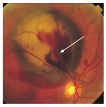 <p>Name the condition</p>