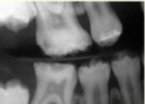 <p><span>Treatment: No treatment is necessary</span></p>