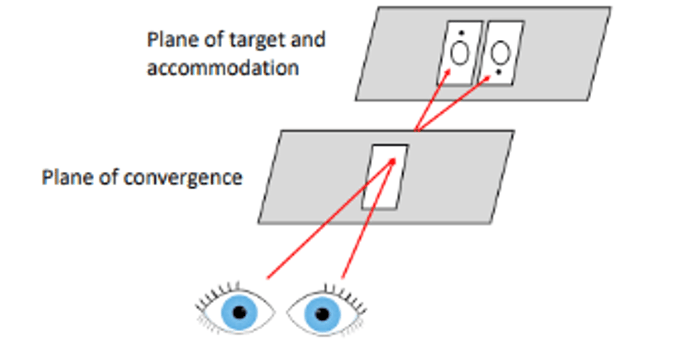 <p>fusion occurring when the plane of vergence is in front of the plane of accommodation</p>