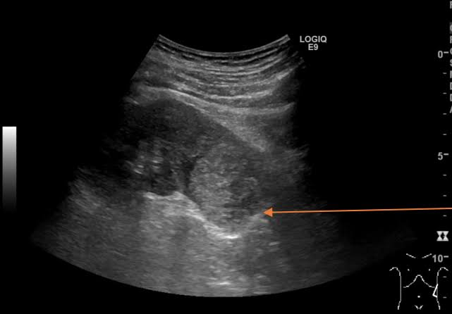 <ul><li><p>solid </p></li><li><p>most are isoechoic </p></li><li><p>the larger the more heterogenous </p></li><li><p>< 3cm they are usually hyperechoic (can look like AML) </p></li><li><p>hypo rim, intramural calcifications </p></li><li><p>invades IVC and renal veins </p></li><li><p>peripheral vascularity “basket sign” </p></li></ul><p></p>