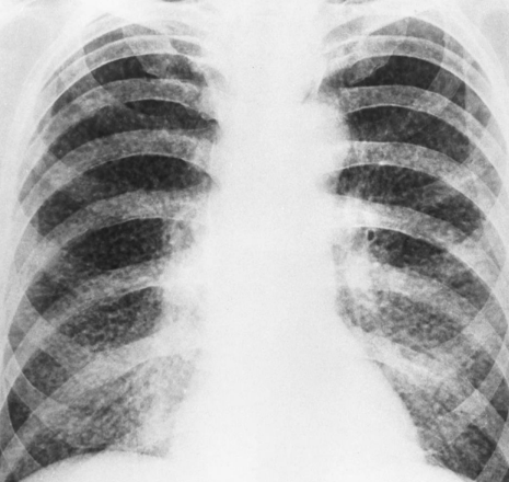 <p>Inhaled irritants retained permanently in the alveolar sacs causing irreversible damage.</p><ul><li><p>Silicosis</p></li><li><p>Asbestosis</p></li><li><p>Anthracosis</p></li></ul><p></p>