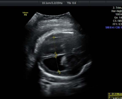<p>What is being depicted in this image?</p><p>a. Hydranencephaly</p><p>b. Dandy-Walker malformation</p><p>c. Porencephaly</p><p>d. Hydrocephalus</p>