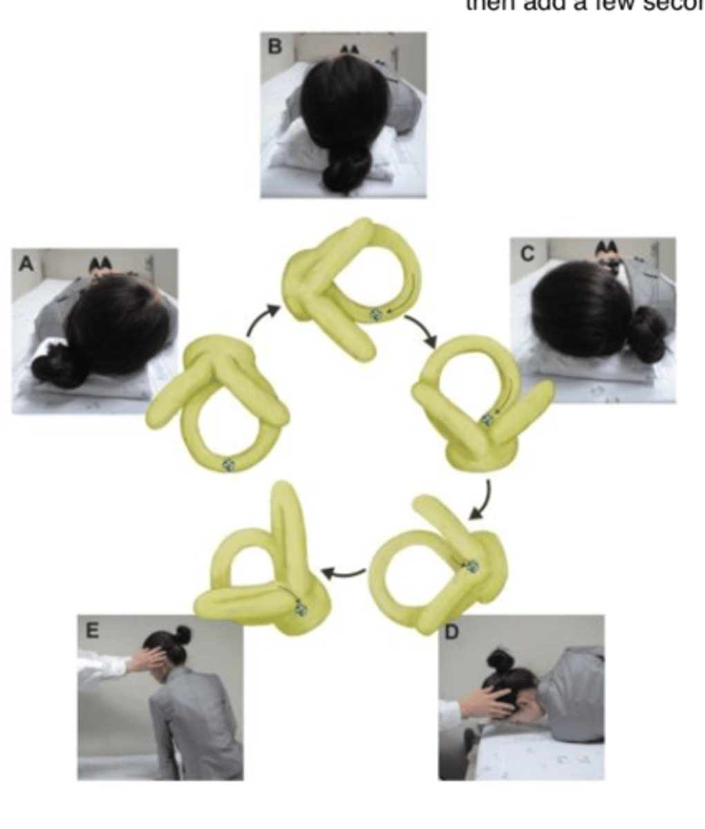 <p>- Patients head should be in 20 deg of cervical flexion</p><p>- After head turning toward the involved ear, head is then turned 270 deg toward unaffected side through a series of stepwise 90 deg turns before resuming sitting position</p><p>- Each position should be maintained for at least 15 sec or until induced nystagmus and vertigo are resolved</p>
