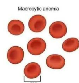 <p>MACROCYTIC</p>
