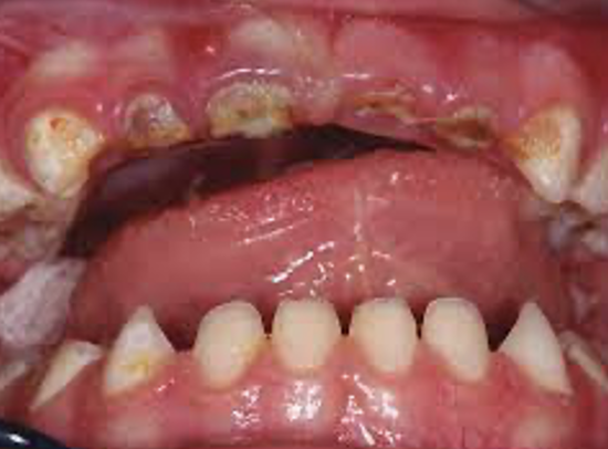 <ul><li><p>Caries occuring in <strong>primary (deciduous) teeth </strong>in young children</p></li><li><p>Different circumstances but the same histological procedure (caries lesion progression)</p></li><li><p>The order of typical locations of caries: Starts on the <strong>maxillary deciduous incisors (52, 51, 61, 62)</strong> on the <strong>gingival part of the vestibular/buccal surfaces</strong>. Later the <strong>deciduous first molars (54, 64, 74, 84) </strong>and <strong>maxillary deciduous canines (53, 63)</strong></p></li></ul><ul><li><p>Affects the <strong>mandibular deciduous incisors less often</strong>, partly because they are protected by the tongue and salivary flow.</p></li><li><p><strong>Can progress quickly,</strong> because deciduous teeth have thinner enamel and dentin</p></li></ul><p></p>